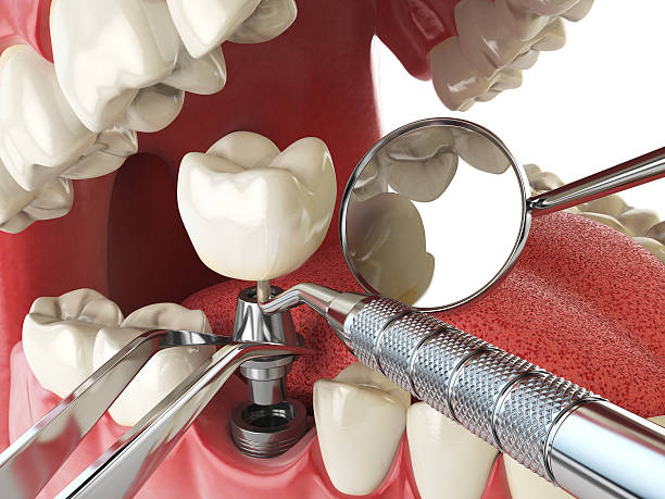 Emergency Cosmetic Dentistry (e.g., broken veneers)